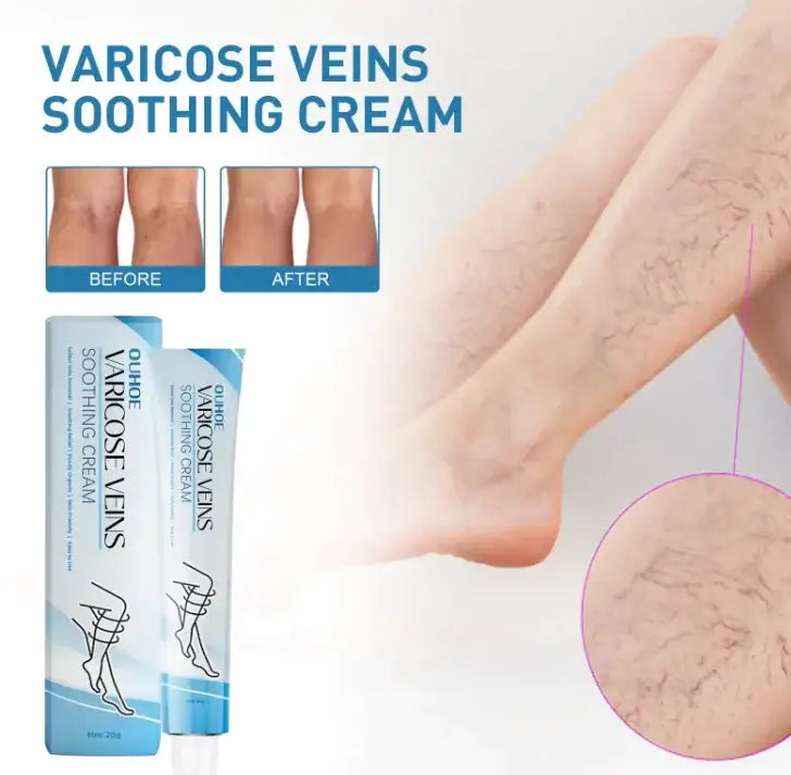 Before and after results using Varicose Veins Soothing Cream on legs to reduce visible varicose veins.