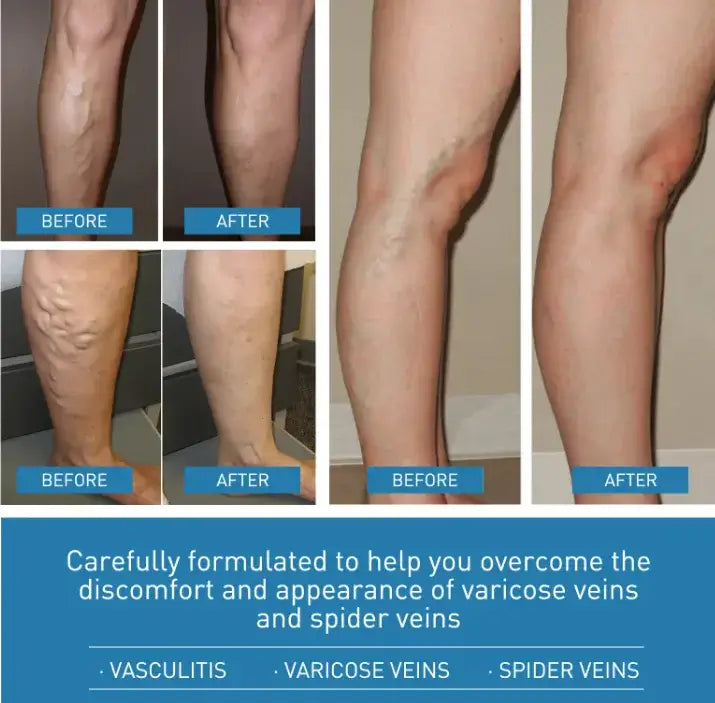 Before and after images showing improvement in the appearance of varicose and spider veins on legs.