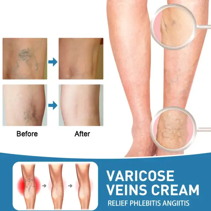 Before and after image of legs showing varicose vein treatment results with varicose veins cream for relief.