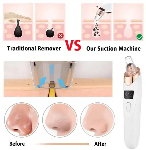 Comparison of traditional blackhead removers vs. Electric Pore Purifier Pro showing effective results.