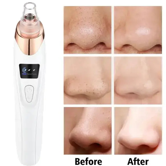 Pore Purifier Pro blackhead remover tool with before and after results showing clearer skin