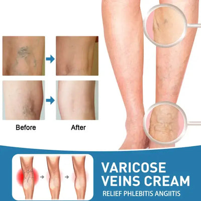 Before and after image of legs showing varicose vein treatment results with varicose veins cream for relief.